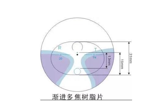 美麗島多焦鏡適合的人群，需要注意的事項(xiàng)