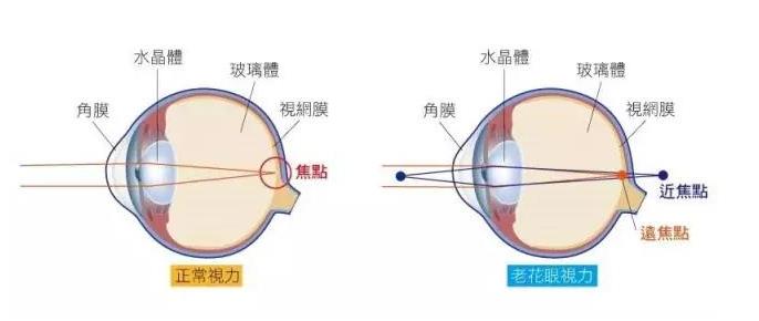 什么是漸進(jìn)老花鏡